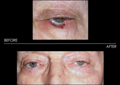 Eyelid Skin Cancer Reconstruction Photos 9