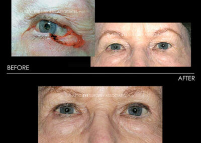 Eyelid Skin Cancer Reconstruction Photos 10
