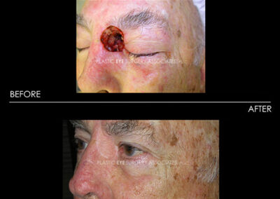 Eyelid Skin Cancer Reconstruction Photos 11