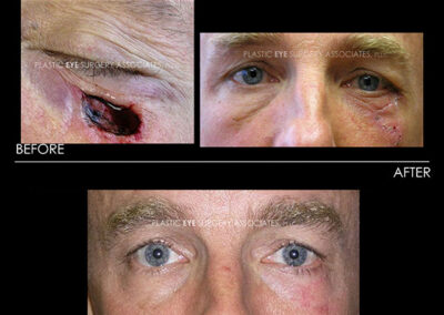 Eyelid Skin Cancer Reconstruction Photos 12