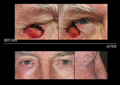 Eyelid Skin Cancer Reconstruction Photos 13