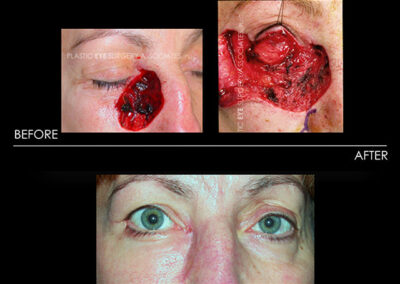 Eyelid Skin Cancer Reconstruction Photos 14