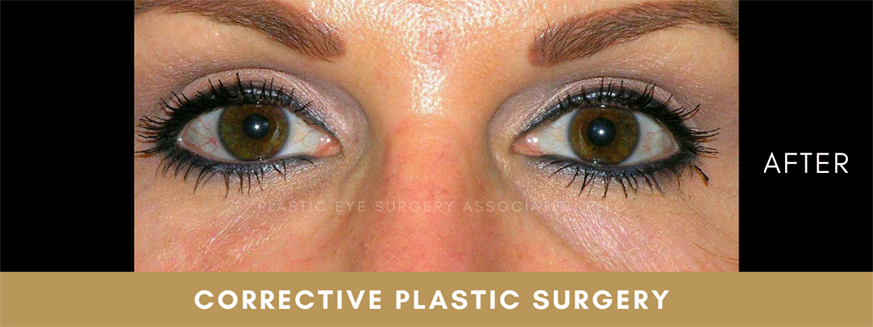 Corrective Plastic Surgery 2