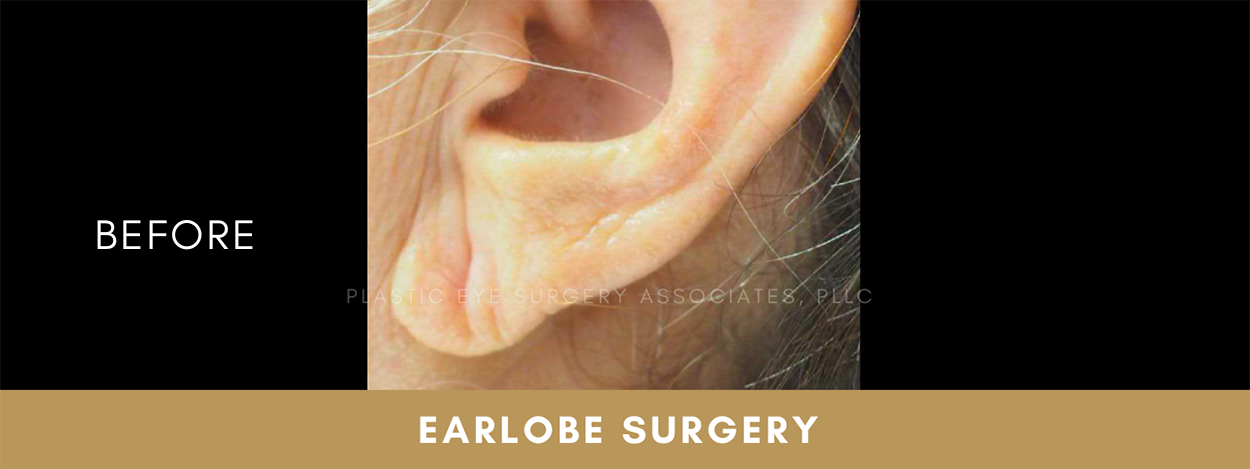 Earlobe Surgery 1