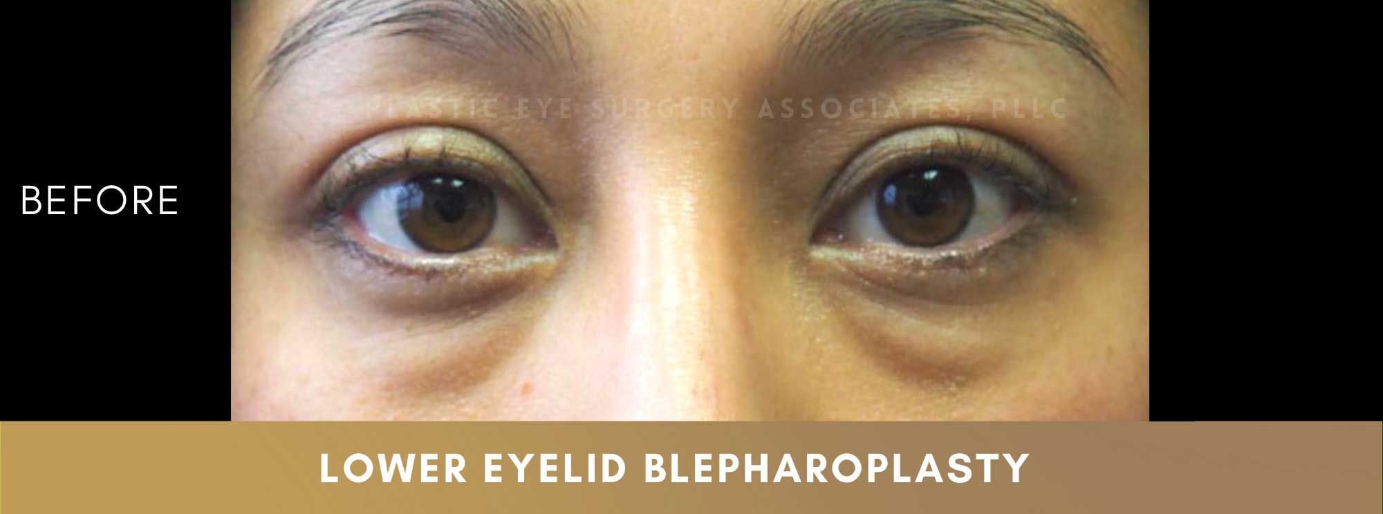 Lower Eyelid Aesthetics 1