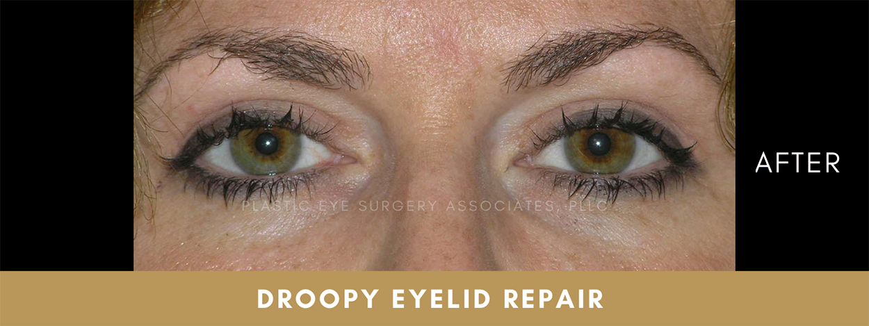 Ptosis Repair (Droopy Eyelid Surgery) 2