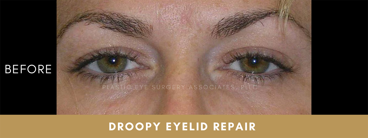 Ptosis Repair (Droopy Eyelid Surgery) 1