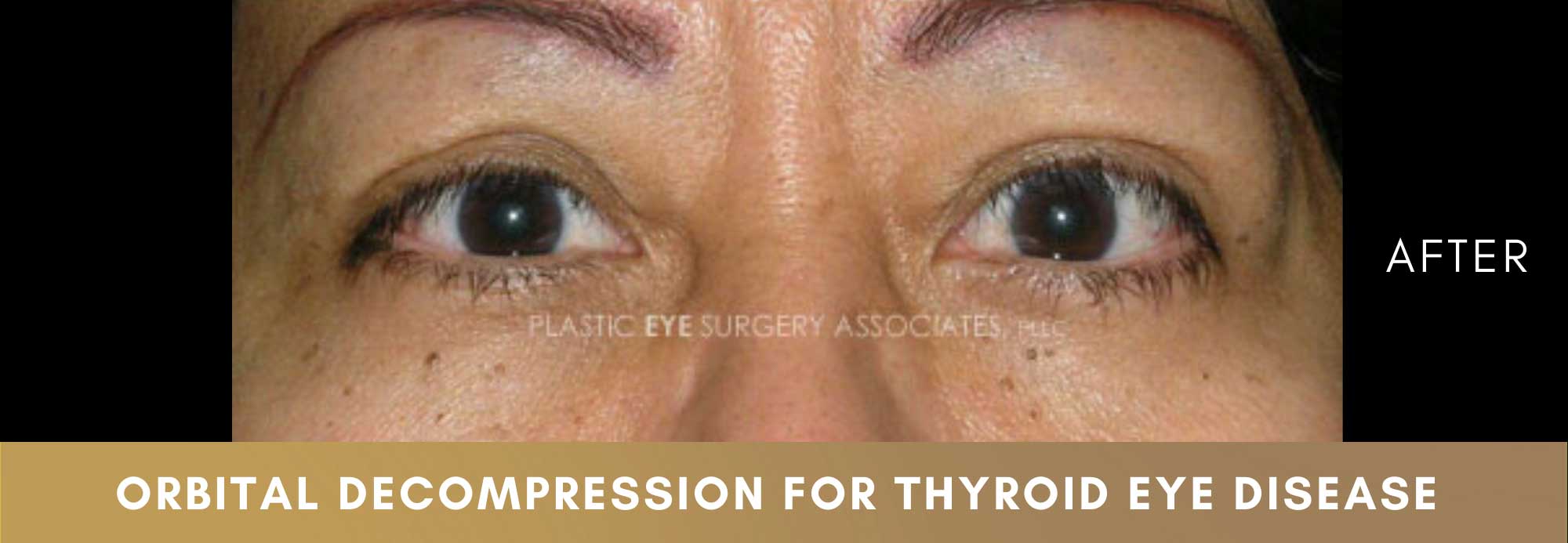 Thyroid Eye Disease 2