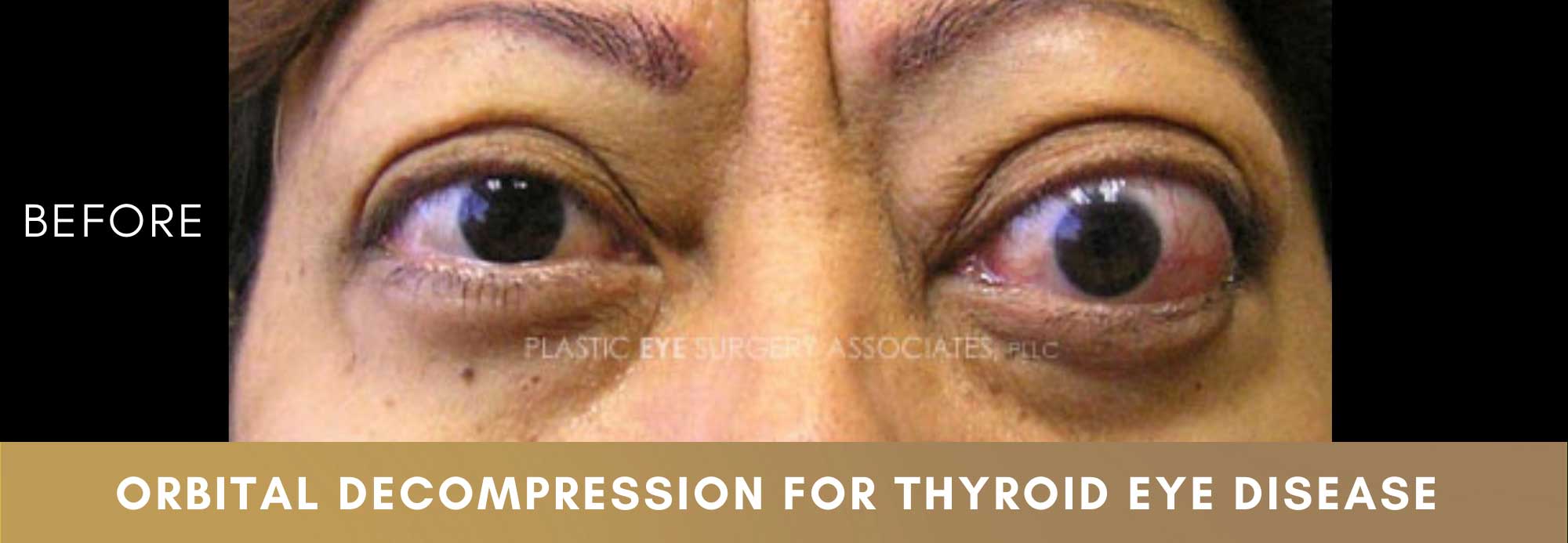 Thyroid Eye Disease 2 Thyroid Eye Disease 1