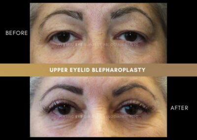 Female Blepharoplasty Photos 24