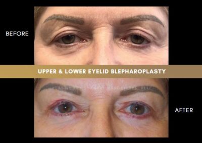 Female Blepharoplasty Photos 34