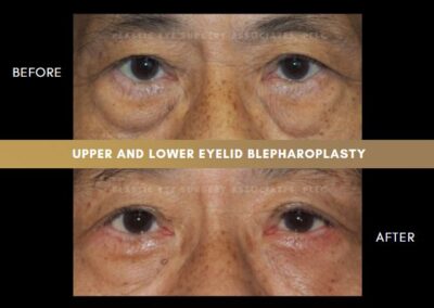 Male Blepharoplasty Photos 2