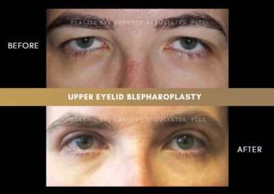 Female Blepharoplasty Photos 40