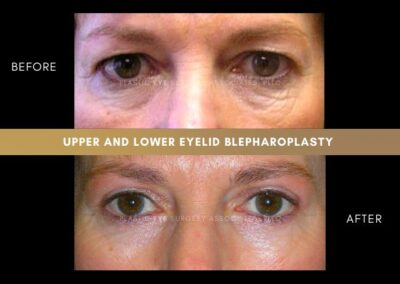 Female Blepharoplasty Photos 23