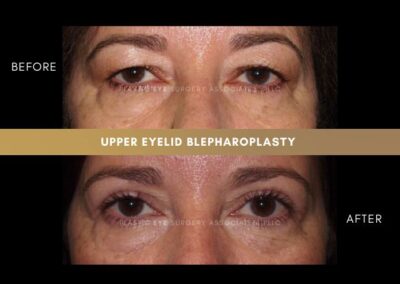 Female Blepharoplasty Photos 19