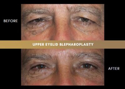 Male Blepharoplasty Photos 5