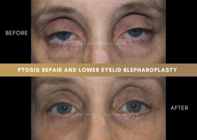 Female Blepharoplasty Photos 26