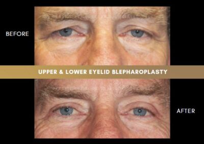 Male Blepharoplasty Photos 4