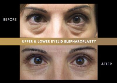 Female Blepharoplasty Photos 36