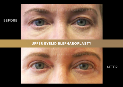 Female Blepharoplasty Photos 10