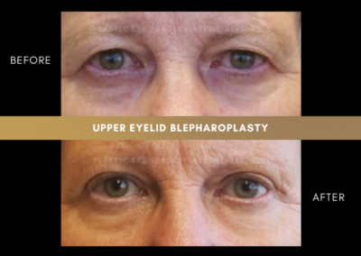 Female Blepharoplasty Photos 14