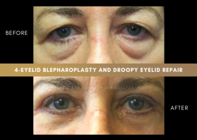 Female Blepharoplasty Photos 12