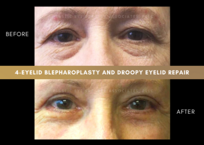 Female Blepharoplasty Photos 11