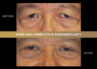 Male Blepharoplasty Photos 1
