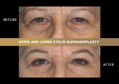 Female Blepharoplasty Photos 9