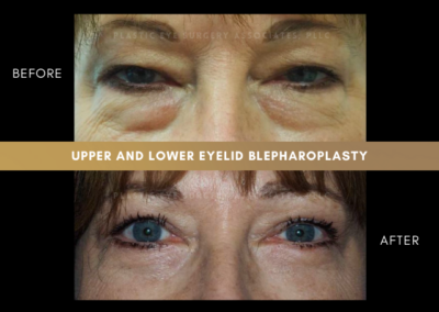Female Blepharoplasty Photos 2