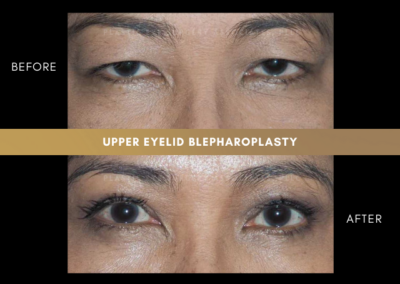 Female Blepharoplasty Photos 1