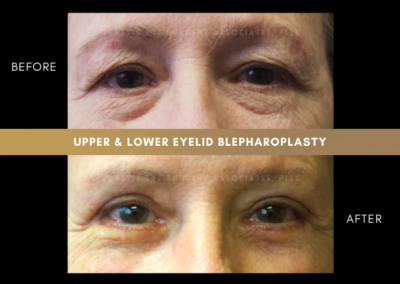 Female Blepharoplasty Photos 8