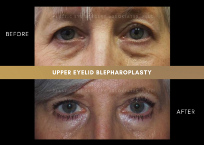 Female Blepharoplasty Photos 7