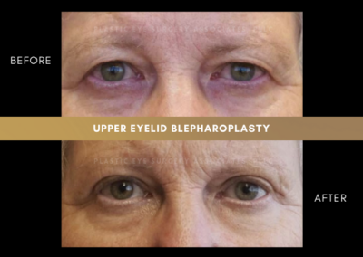 Female Blepharoplasty Photos 6