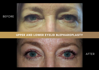 Female Blepharoplasty Photos 5