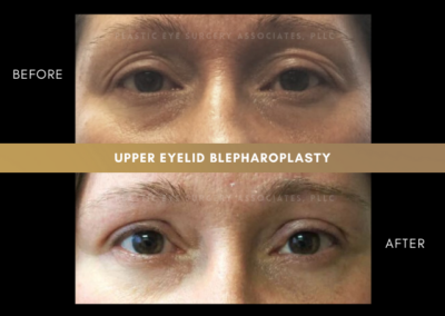Female Blepharoplasty Photos 4