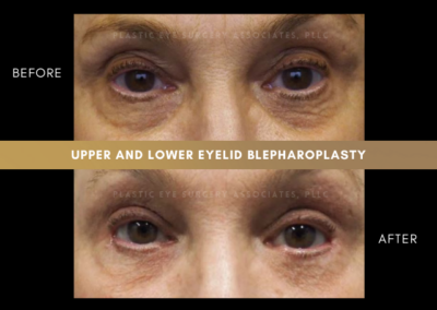 Female Blepharoplasty Photos 3