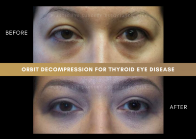 Thyroid Eye Disease Photos 55