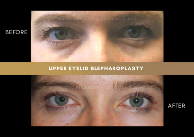 Female Blepharoplasty Photos 27