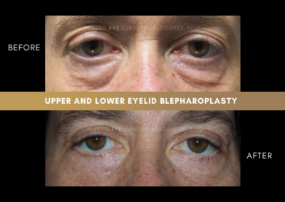 Female Blepharoplasty Photos 26