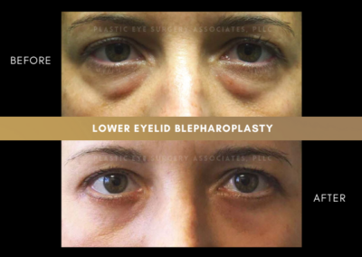 Female Blepharoplasty Photos 25