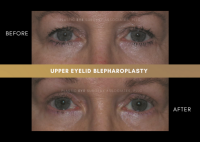 Female Blepharoplasty Photos 23