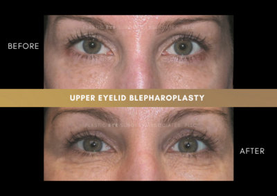 Female Blepharoplasty Photos 22