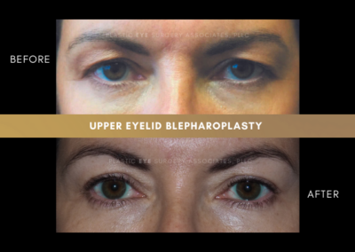 Female Blepharoplasty Photos 20