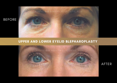 Female Blepharoplasty Photos 19