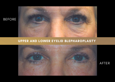 Female Blepharoplasty Photos 3