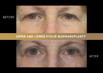 Female Blepharoplasty Photos 2
