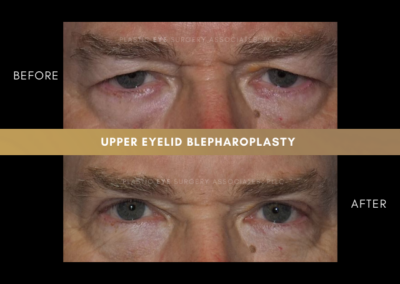Male Blepharoplasty Photos 1