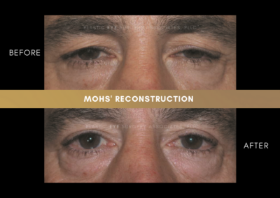 Male Blepharoplasty Photos 4