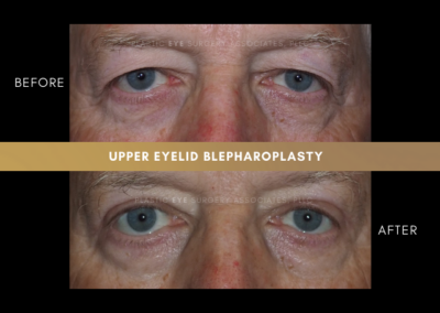 Male Blepharoplasty Photos 3